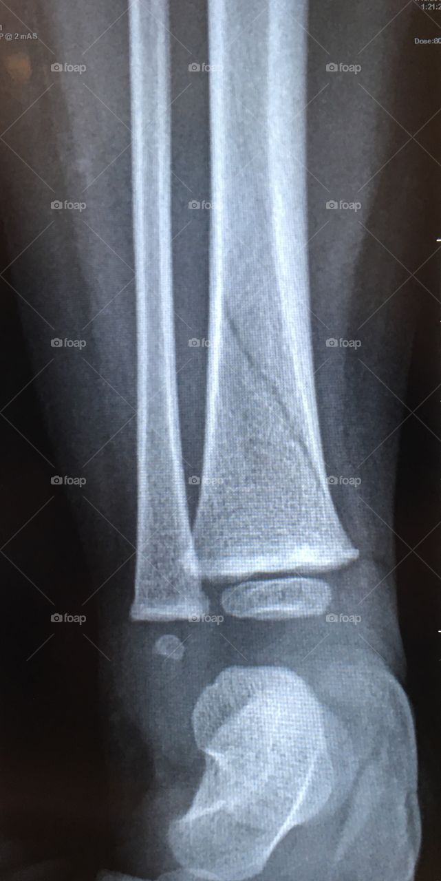 Toddler Fracture