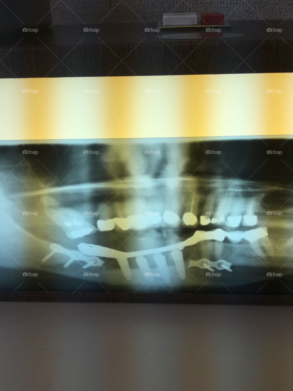 X-ray. Jaw. Titanium. Implant. Teeth. Mouth. Crowns. Reconstruction. Pain. Extensive. Expensive. Dental work. Surgery. Screws. 
