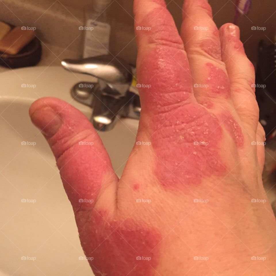 Psoriasis on hand close up