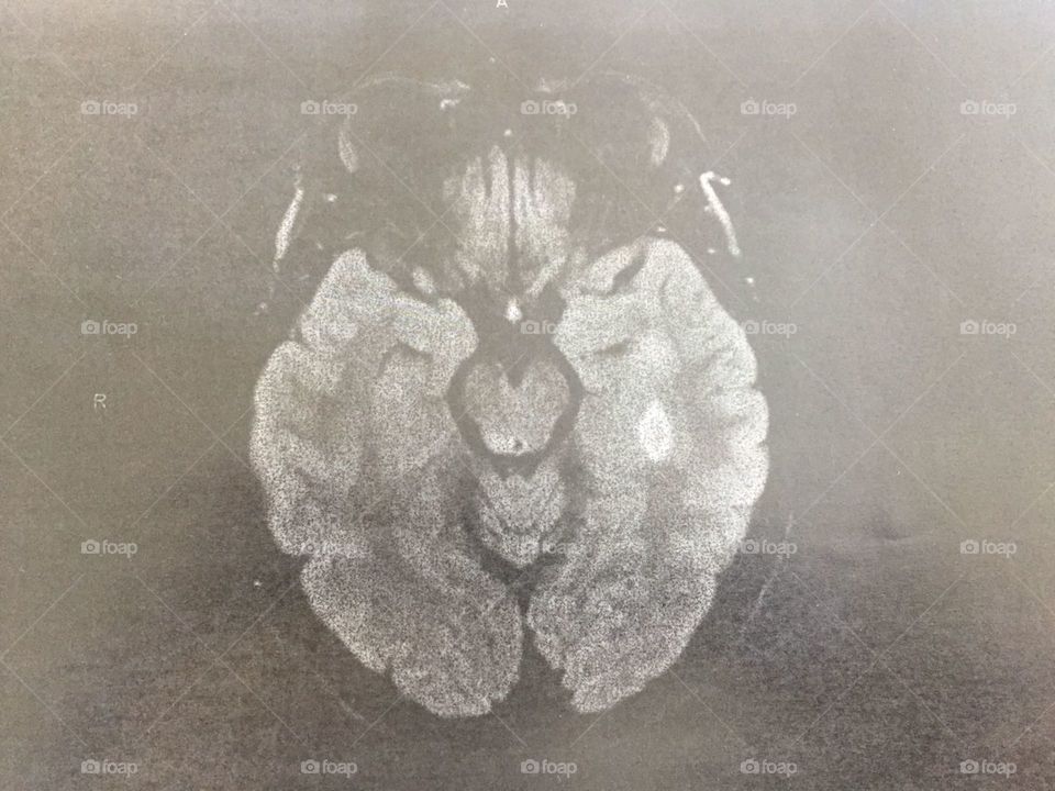 Multiple sclerosis MRI