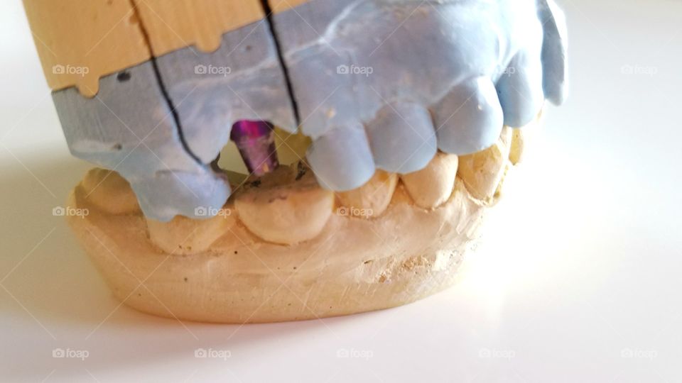 Dental impressions