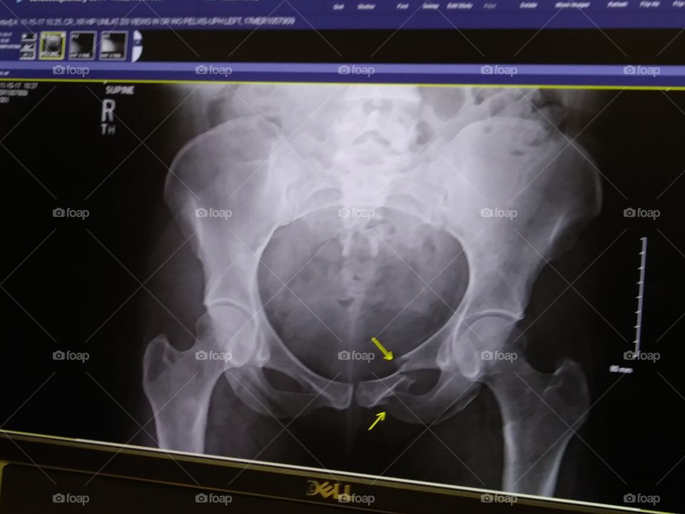 45 Days, 2 fracture s, Finally got an X-ray