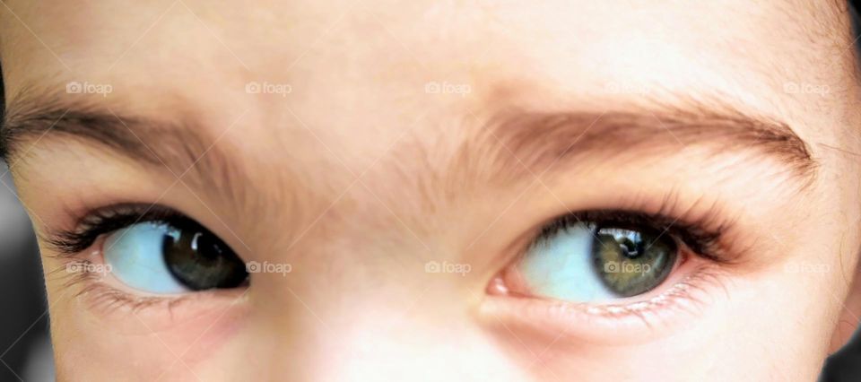 Child with central heterochromia