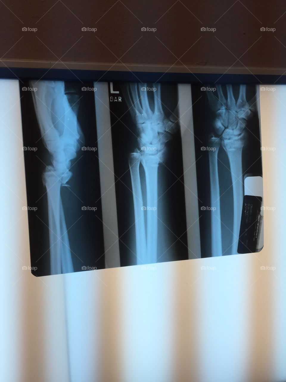 X-ray of broken wrist from kiteboarding accident