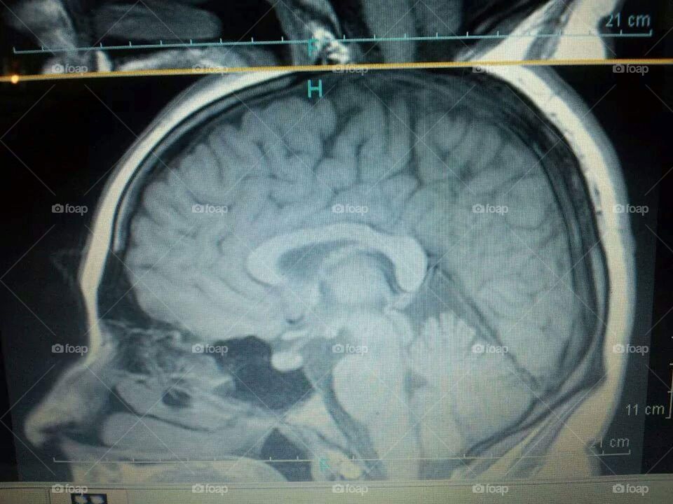 This is a picture of my brain from an MRI scan. Just thought it was super cool to see my brain. 