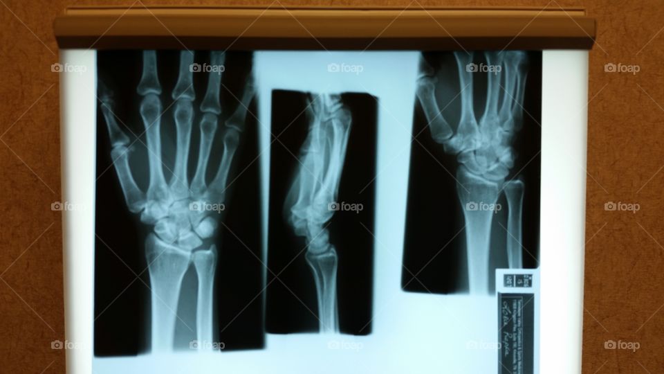 X-rays of hand on light box