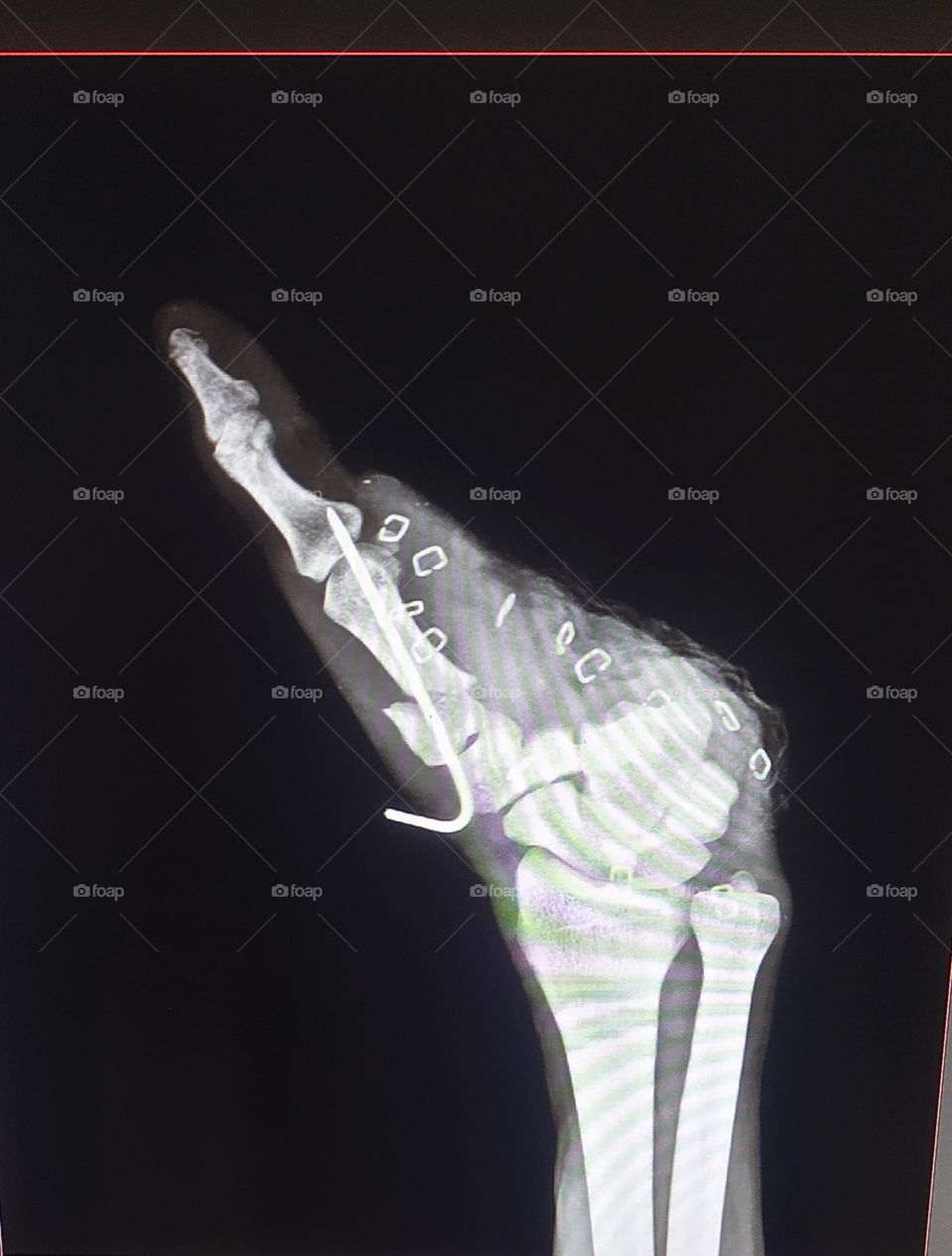 Hand Ap X-ray view shows K-wire procedure for industry accidental case