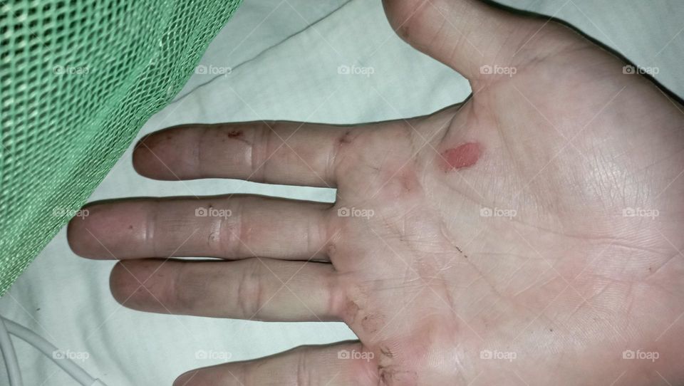 a hand full of wounds