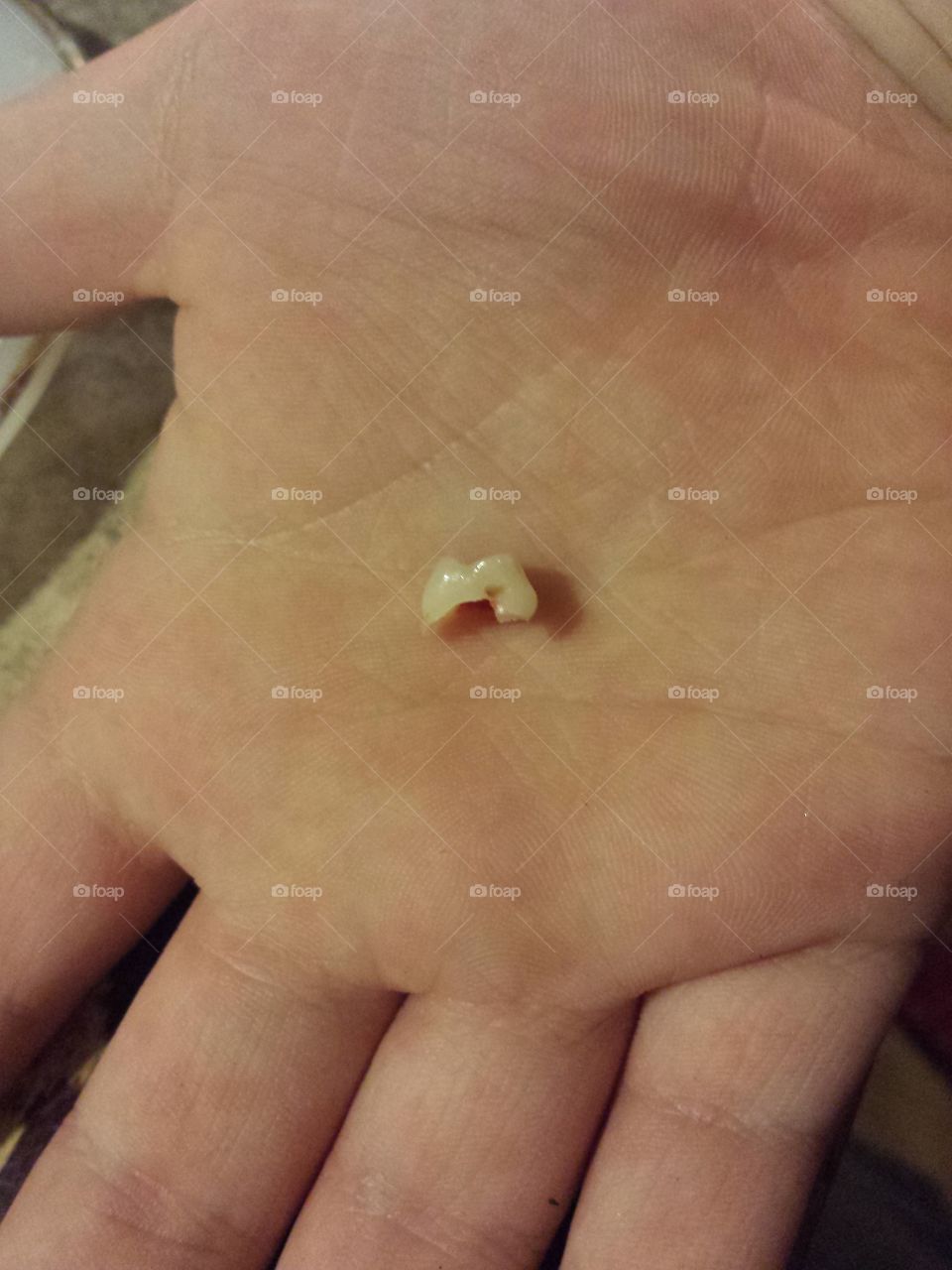 baby tooth