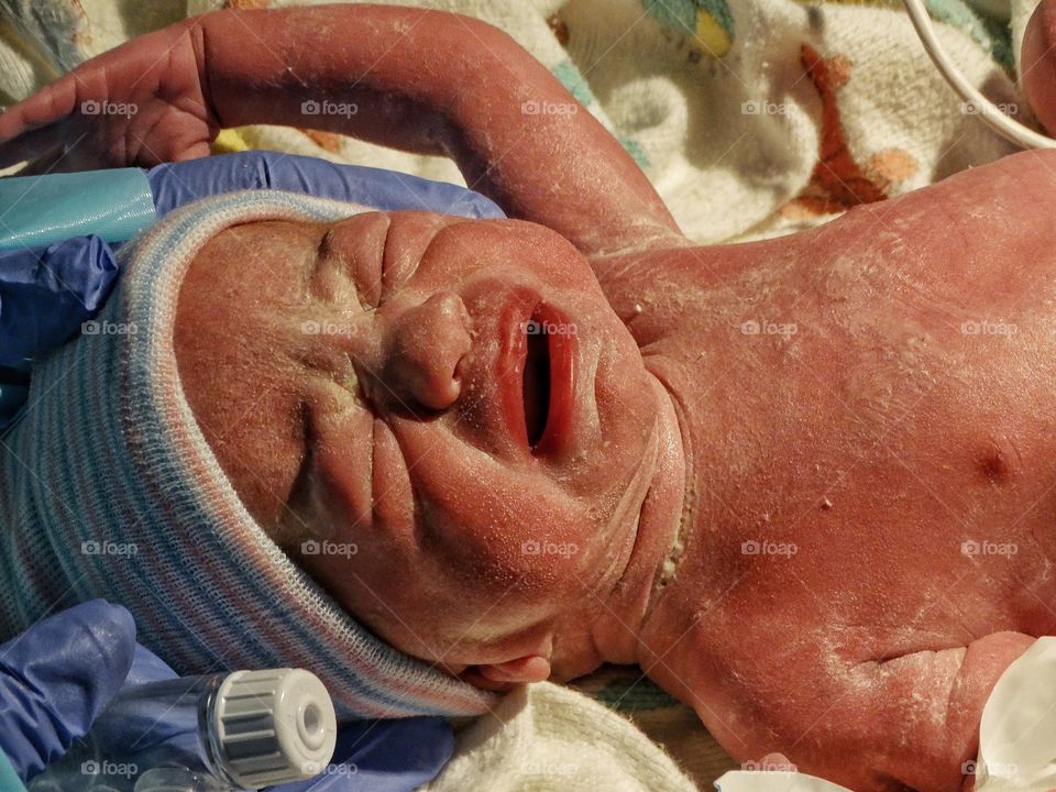 Premature Newborn Infant
