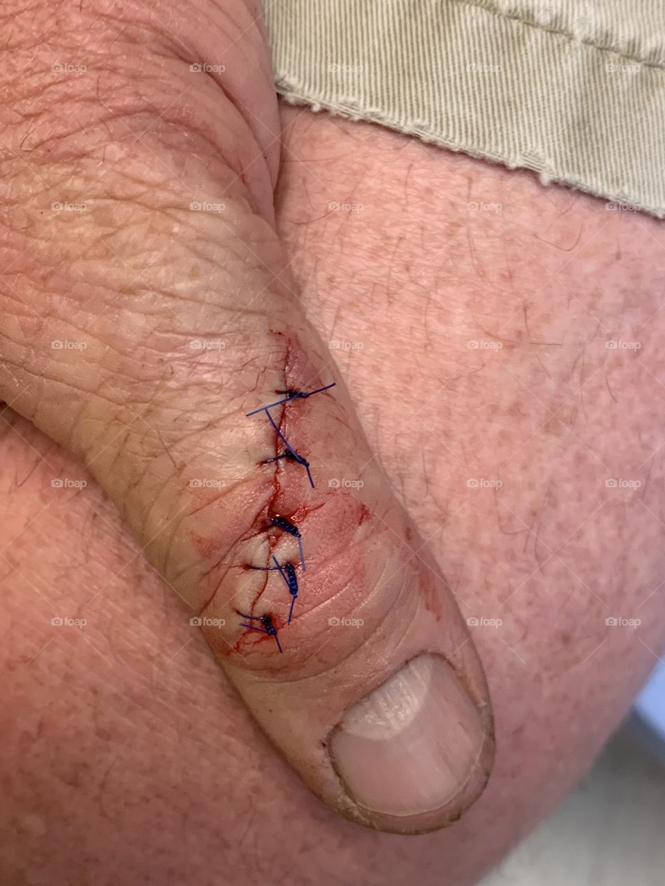 Stitches in thumb