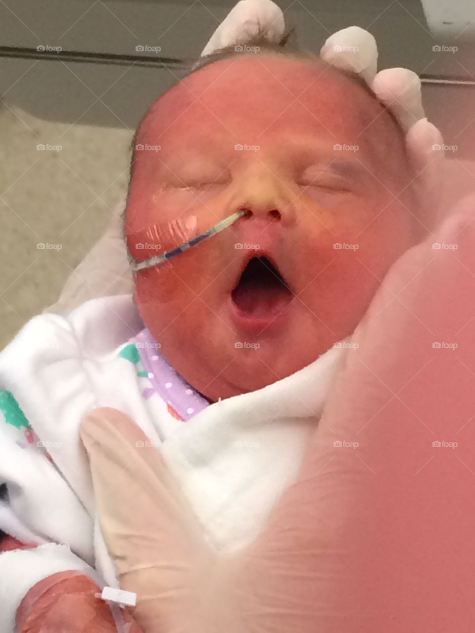 Newborn with Down syndrome soon after birth, yawning, birth diagnosis