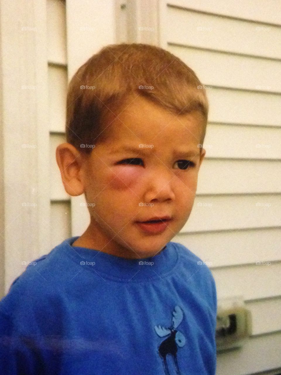 Swollen under the eye from a bug bite.