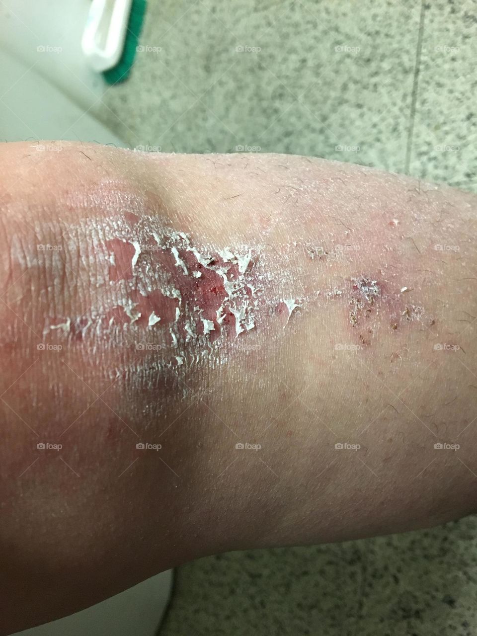 Nasty scrapped knee and leg of a middle aged woman, who fell on some rocks at the beach, when out camping 