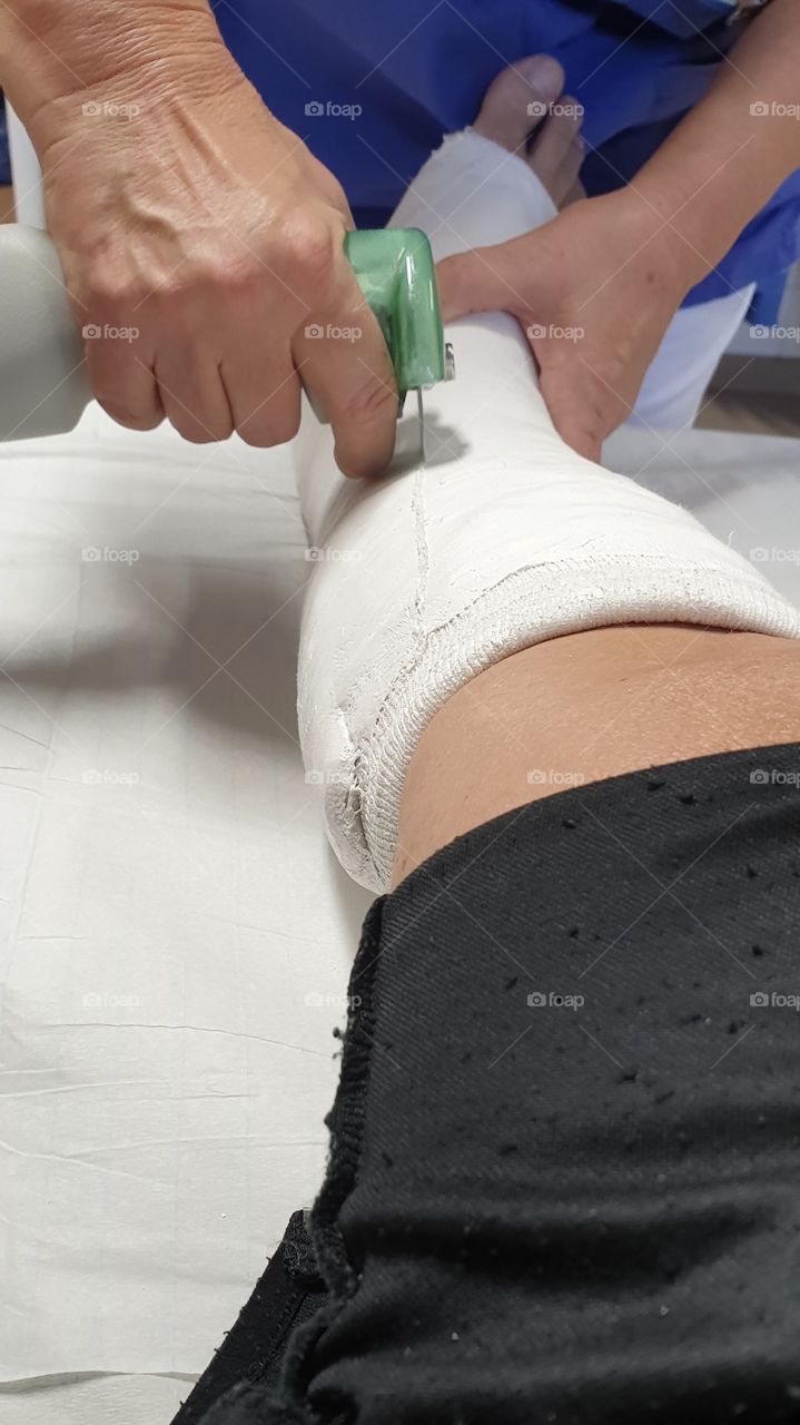Removing short leg cast with cast saw , avgipsning underben gips gipssåg 
