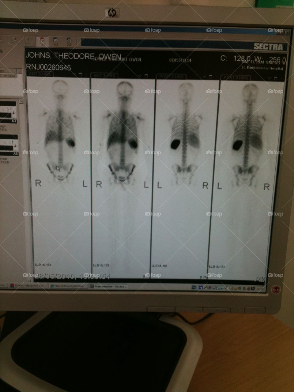 Nuclear scan of my body! 