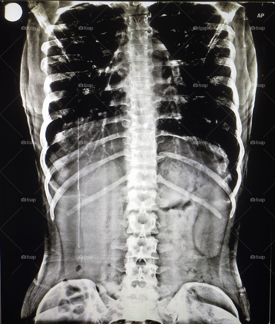 Digital Xray of thorax  or lumbar spine Ap view