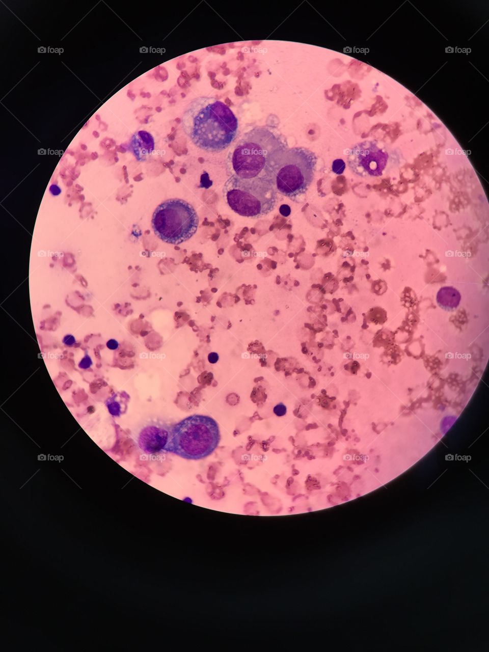 Mesothelial cell (plueral fluid)