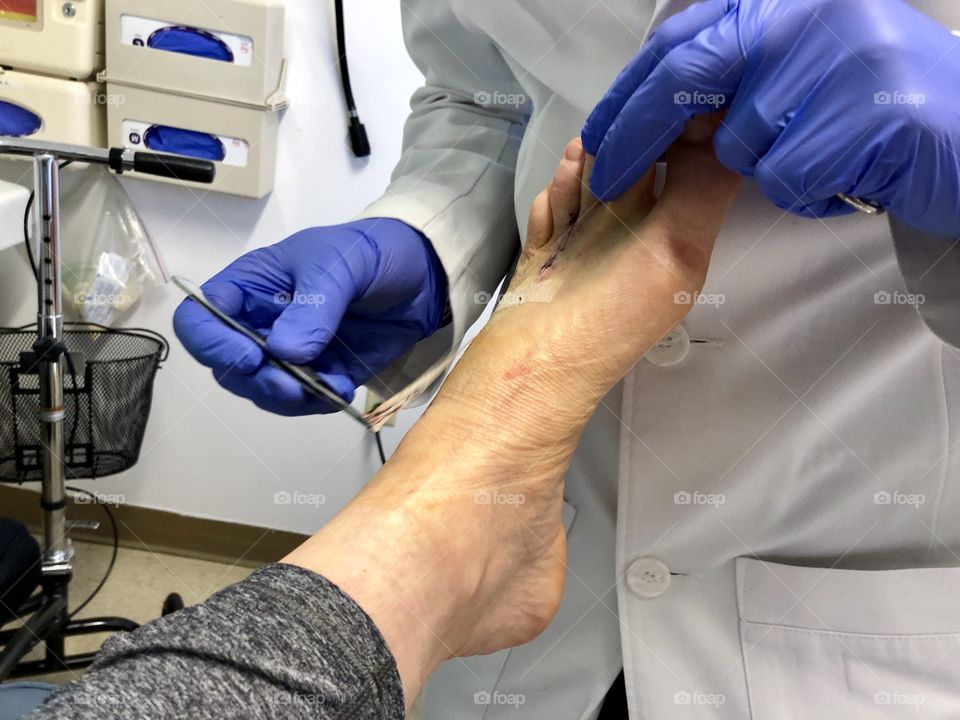 A Morton's Neuroma surgical patient at a post-op appointment as the doctor removes the bandaged to check the incisions.