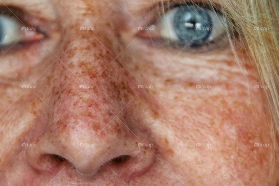 Close-up of part of a woman's face with blue eyes and many freckles on the skin