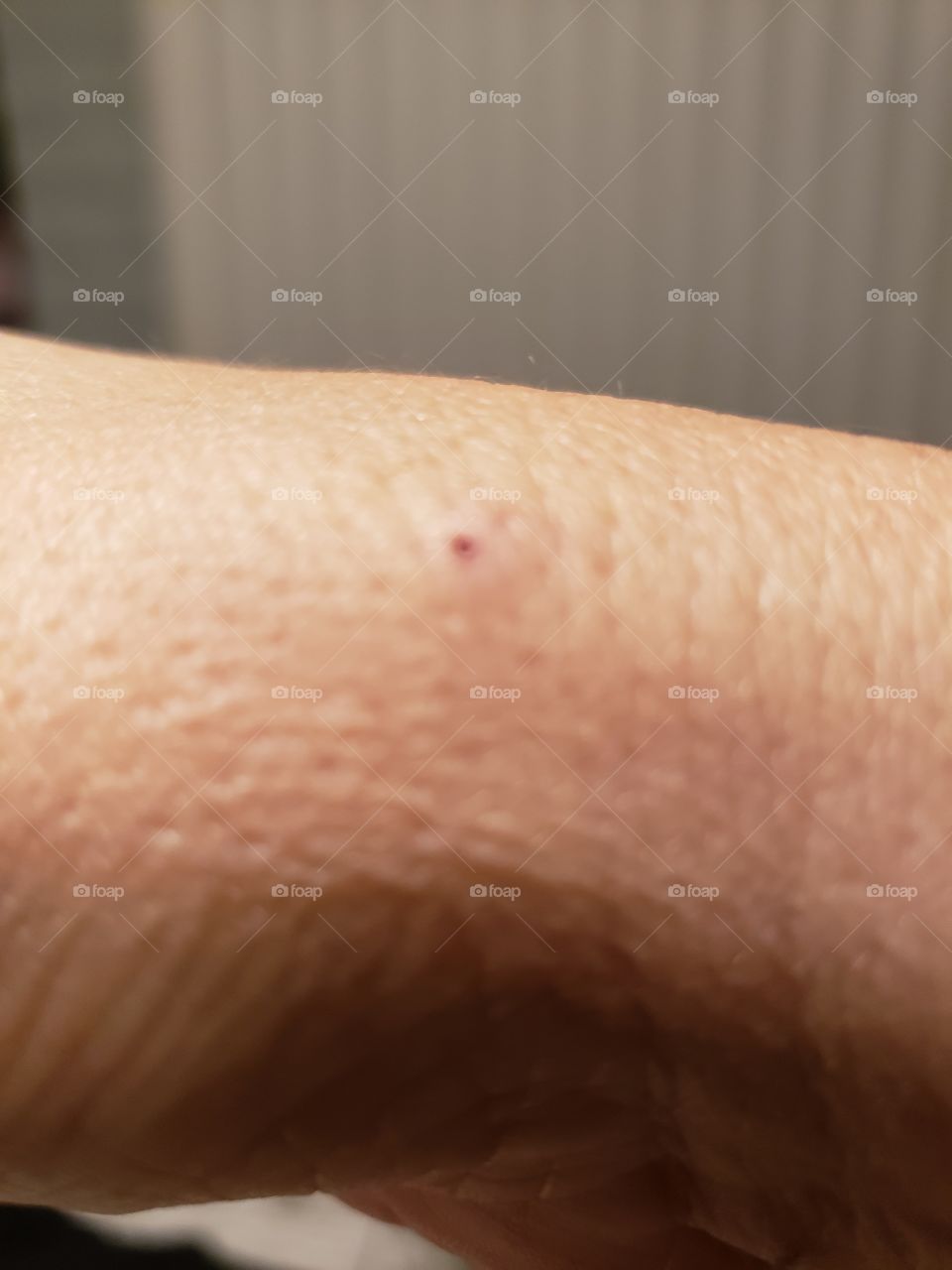 IV vein rolled 1st attempt