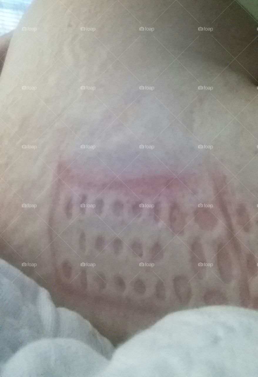 found my stereo remote under the edge of my butt when I woke up, nice imprint. Since I can't feel anything from my chest down due to a severed spinal cord, I had no idea it was there.