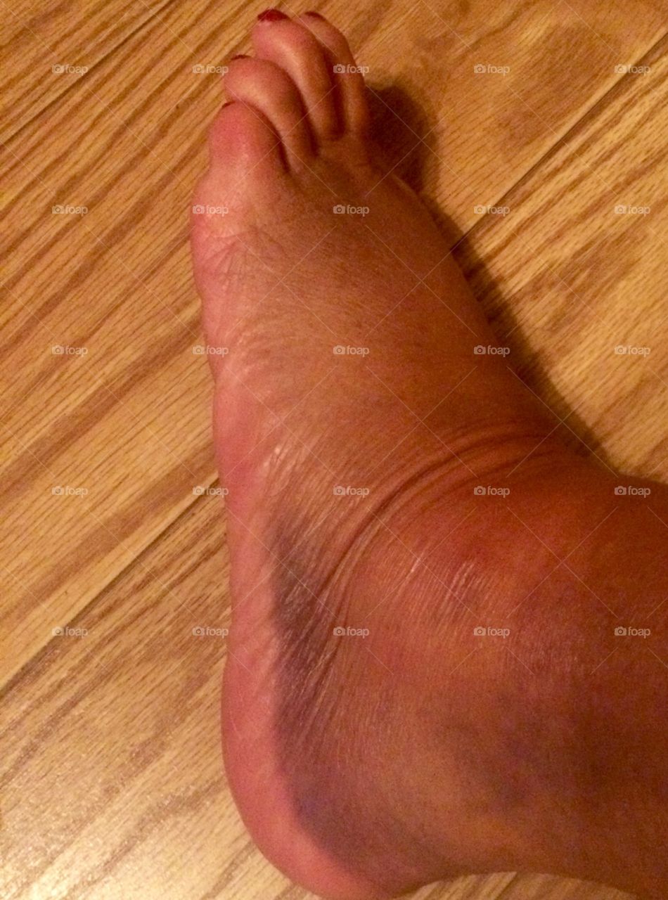 Sprained Ankle