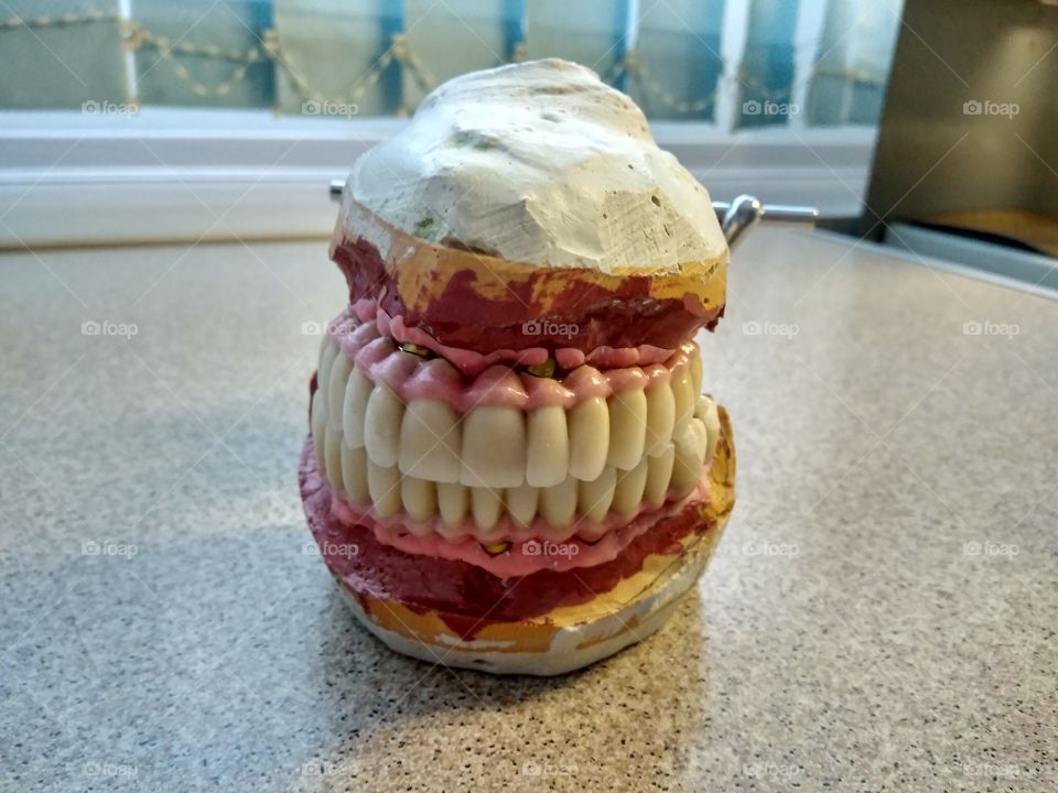 Ceramic dental bridge on implantant model