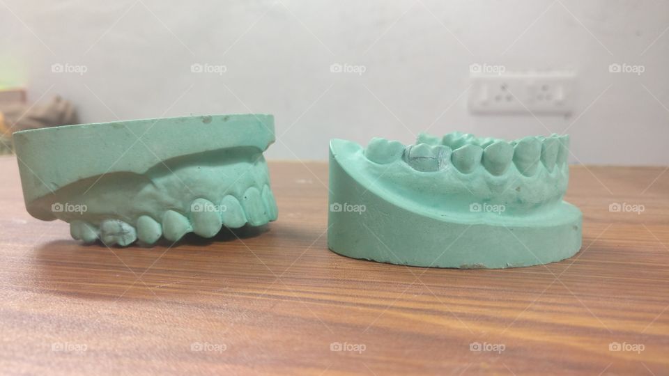 maxillary and mandibular cast