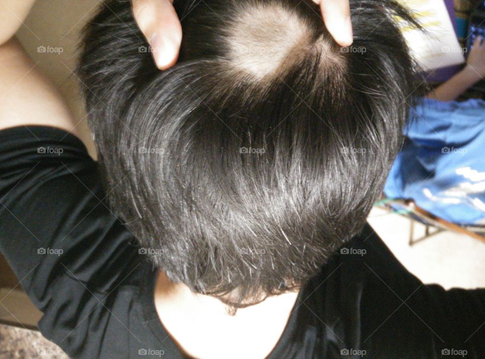 Sudden hair loss. I suffered from alopecia areata