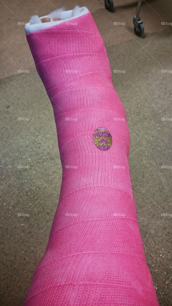 Person's broken leg in a plaster cast