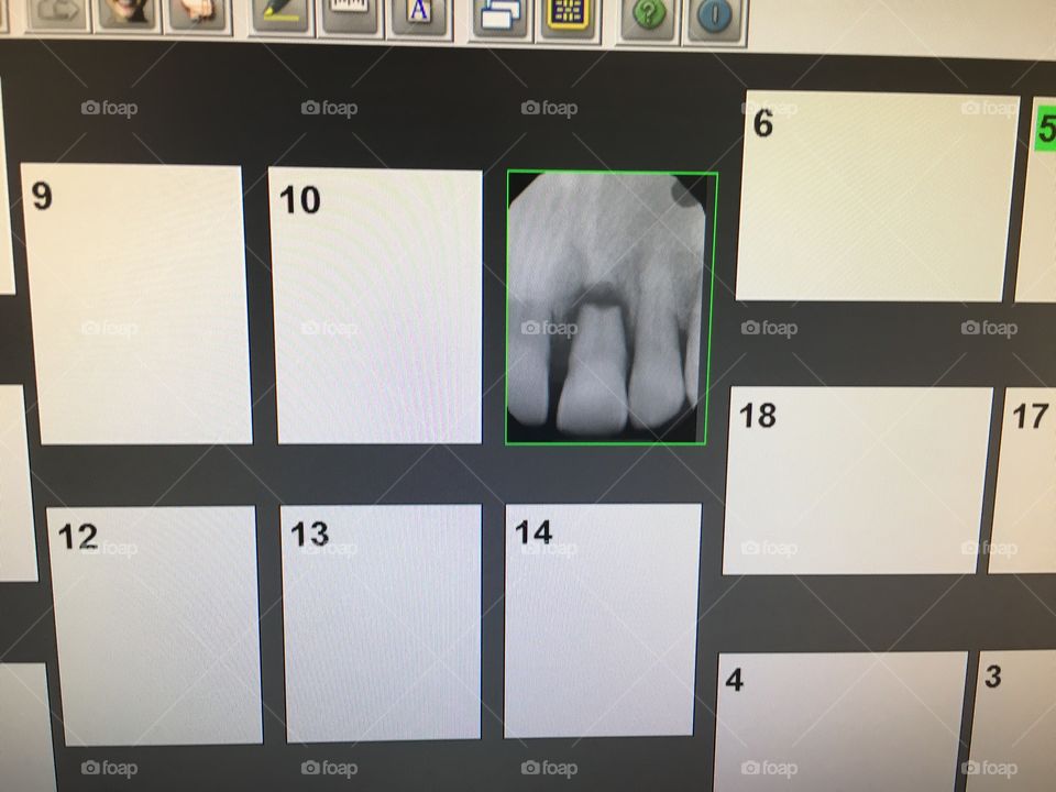 X-ray of broken tooth