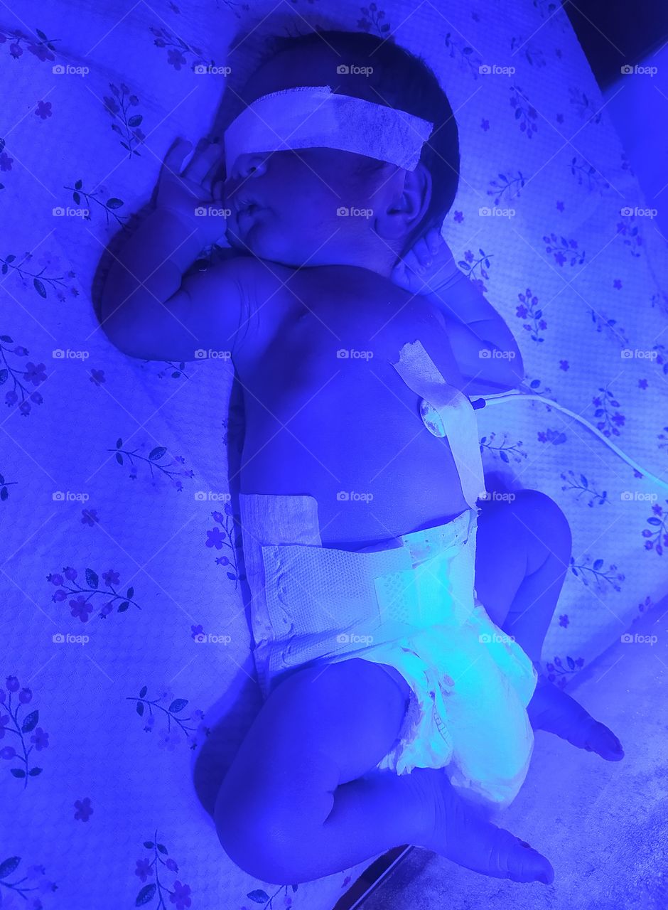 Phototherapy treatment for jaundice disease to NICU baby in Multispeciality hospitals