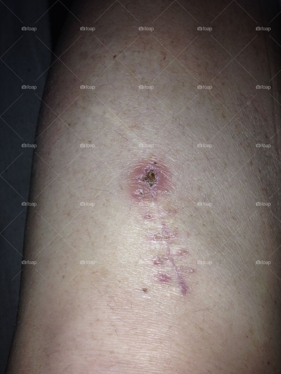 Scar from an knee operation