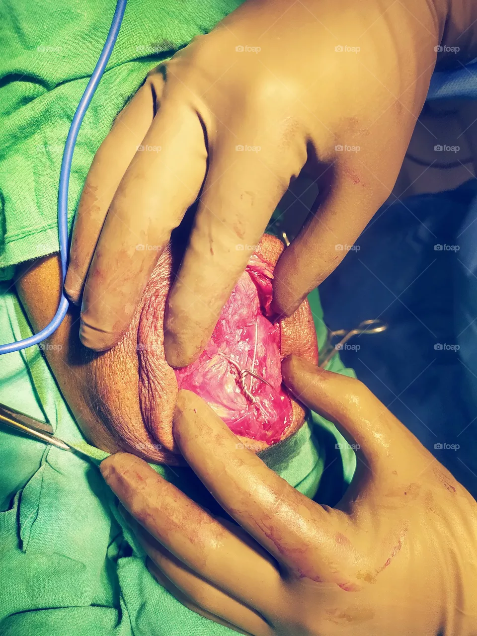 Patella bone procedure operation theatre close-up view shot on Camera