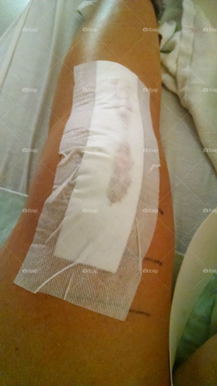 Post Operative Total Knee Replacement