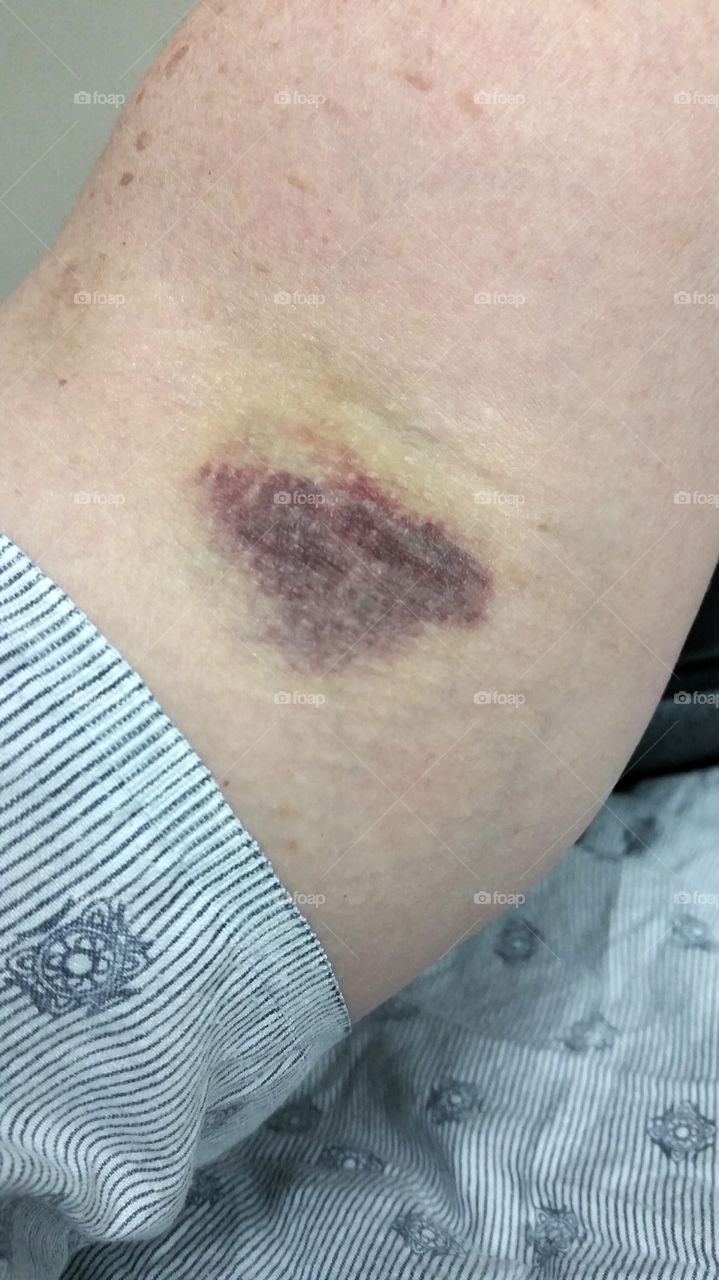 Bruise close up