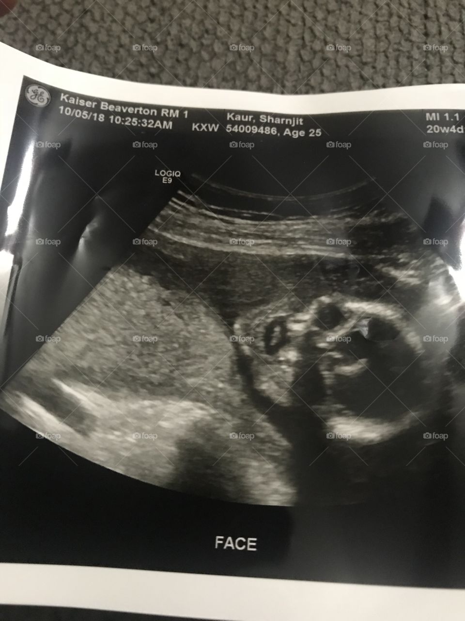 Ultrasound of my first baby girl of 4 month 