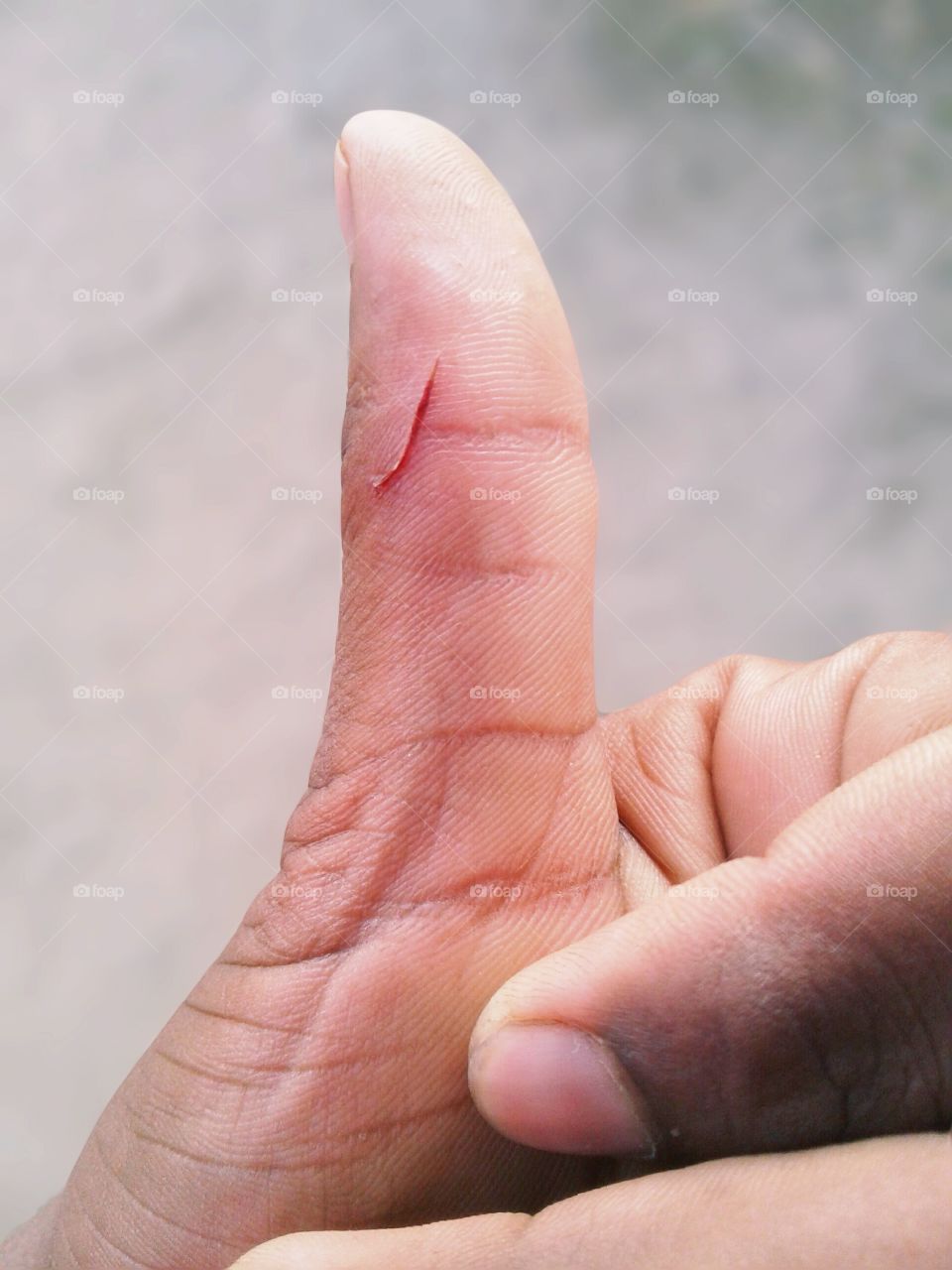 A knife was injured on the thumb of the hand.