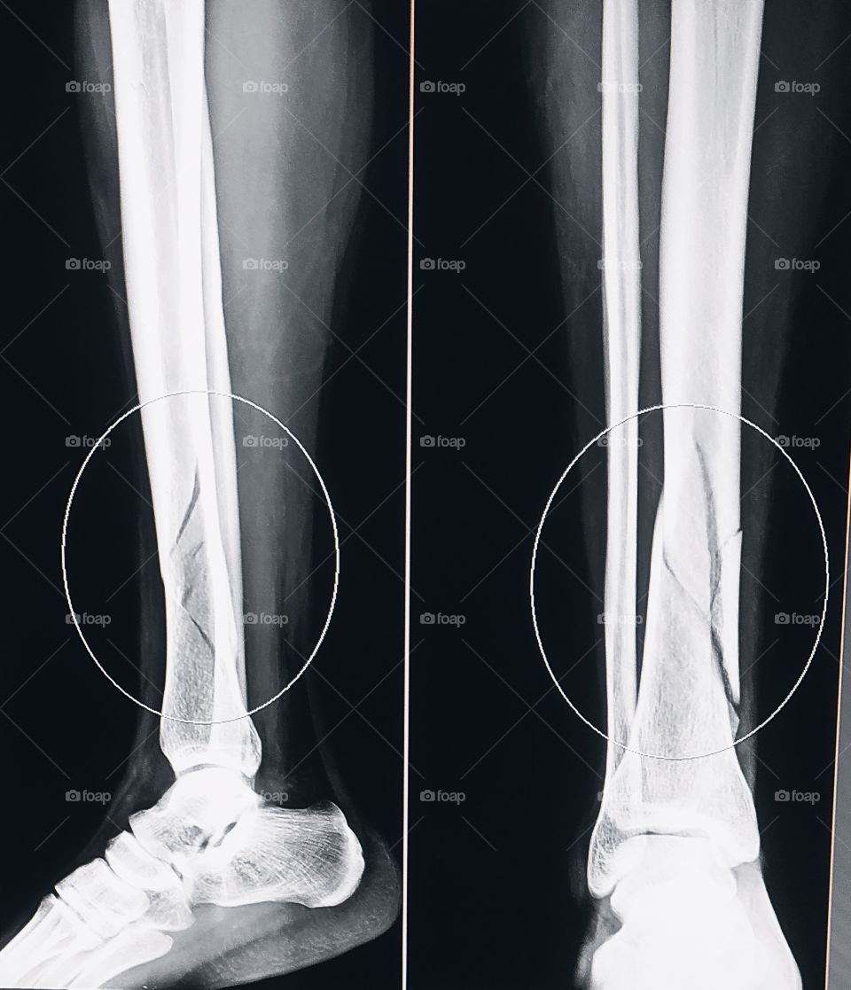 Tibia Fracturs X-ray Ap/lateral View accidental injury