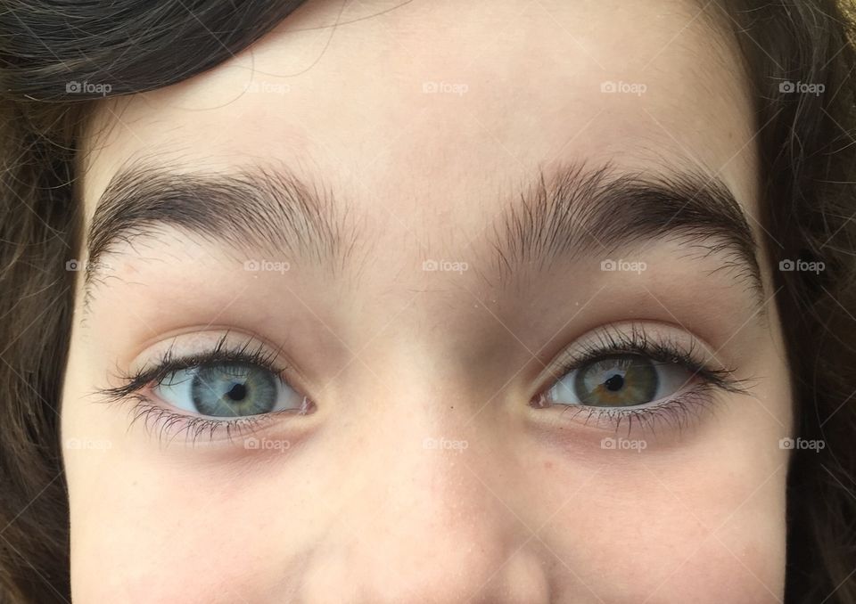 Heterochromia, eyes of different colours 