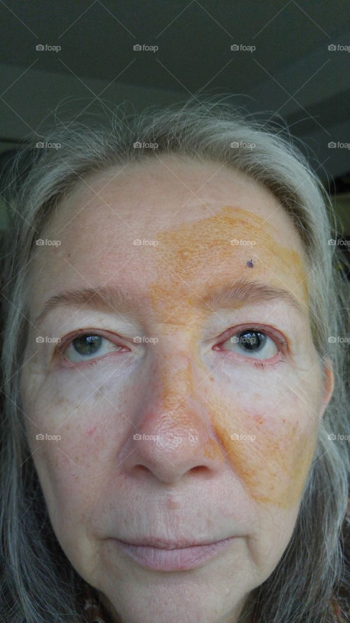 After left-eye cataract surgery