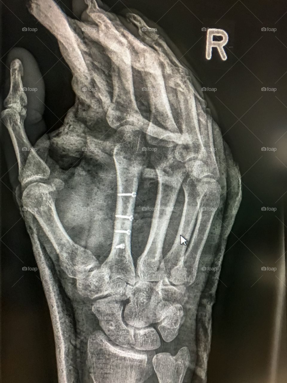 Broken hand bone 9