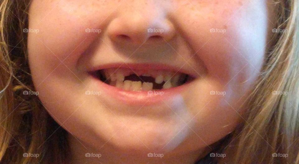 two front teeth