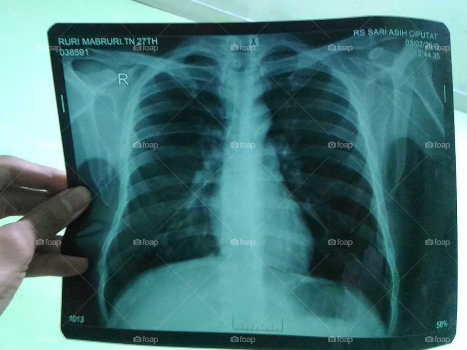 Lung after X-Ray