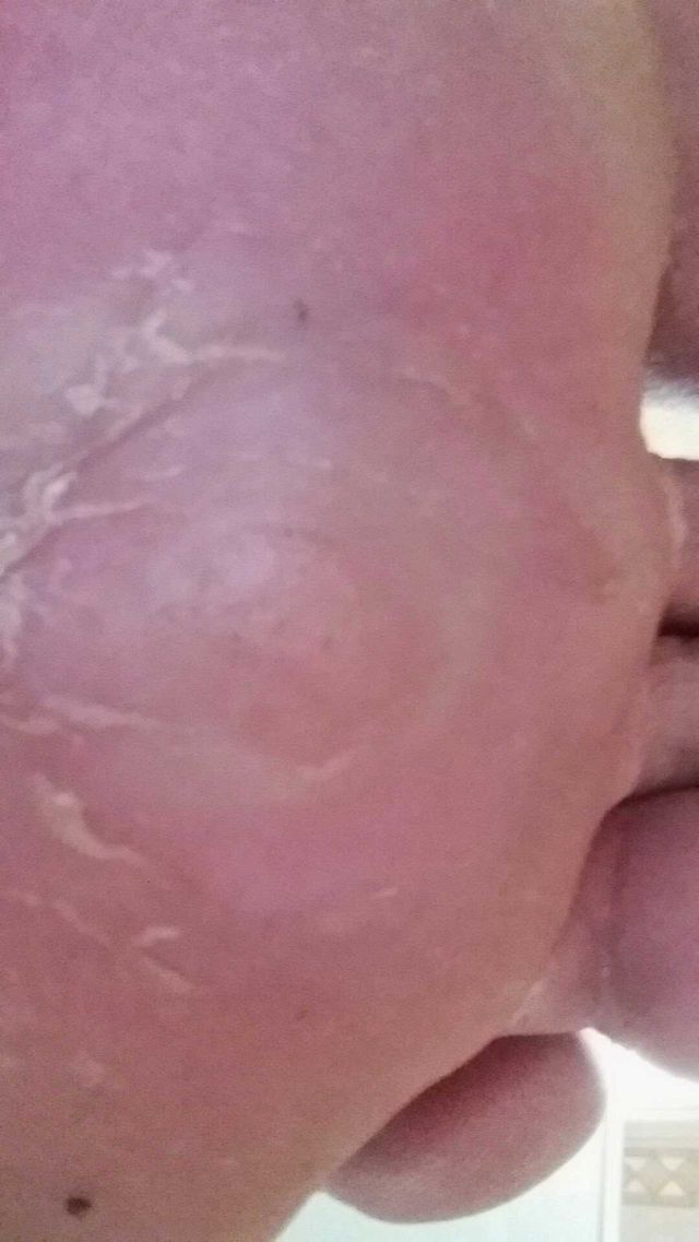 fungus on the foot