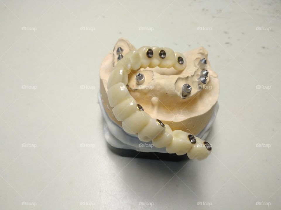 Dental implants